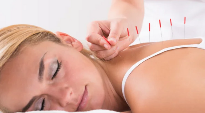 ¿Qué es la acupuntura y cuáles son sus beneficios?
