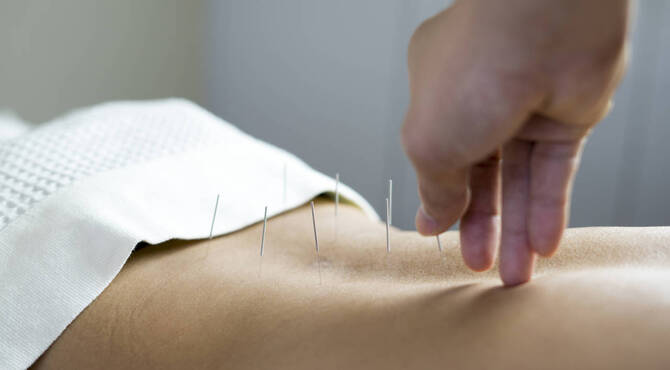 ¿Qué es la acupuntura y cuáles son sus beneficios?